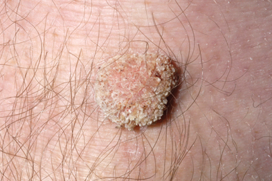 Mole Removal Minimal Downtime Treatments